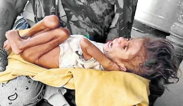 भूख से बेहाल नौनिहाल, राजधानी में मिला 4 साल का अतिकुपोषित बच्चा