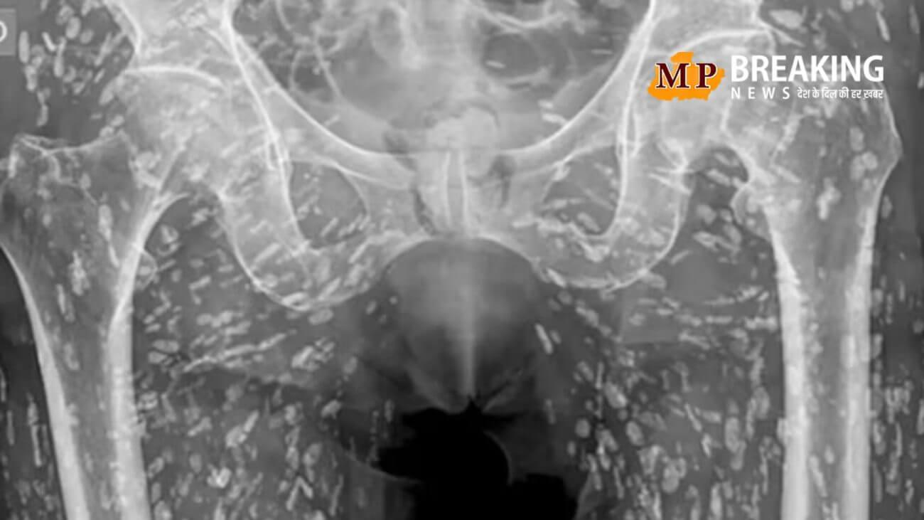 मरीज के एक्स-रे ने उड़ाए डॉक्टरों के होश, लगा मानो शरीर के अंदर हुई हो आलोवृष्टि! जानिए क्या है इसका मांस खाने से संबंध