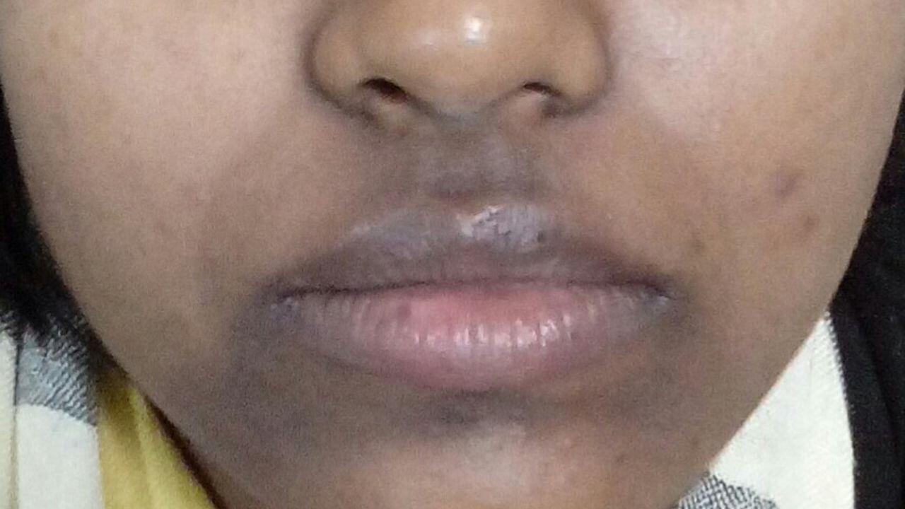 होंठों के आसपास के कालेपन को हटाएं, बस चावल का आटा और शहद इस तरह लगाएं