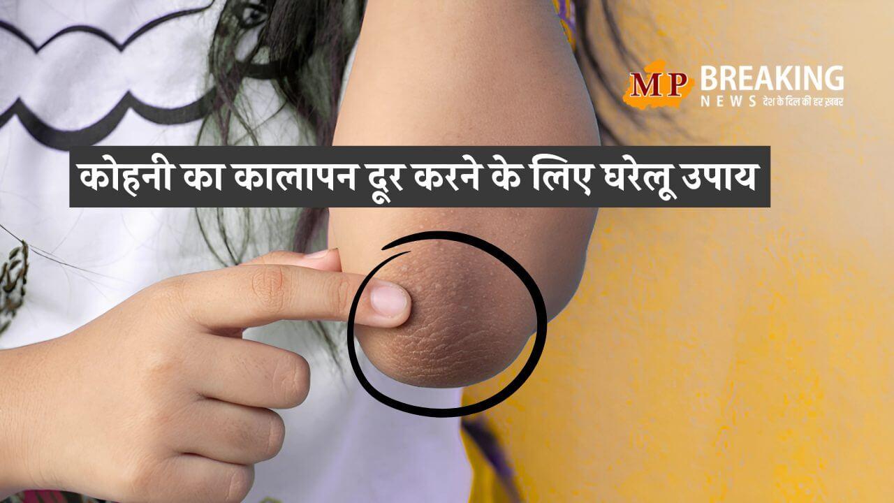 कोहनी का कालापन हटाएं, इन आसान घरेलू उपाय से डेड सेल्स को कहें अलविदा!