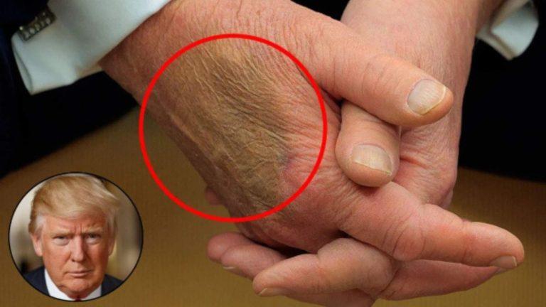 डोनाल्ड ट्रंप के हाथ पर नीले निशान, व्हाइट हाउस ने खोला सेहत का राज, ‘क्रोनिक वेनस इनसफिशिएंसी’ का खुलासा