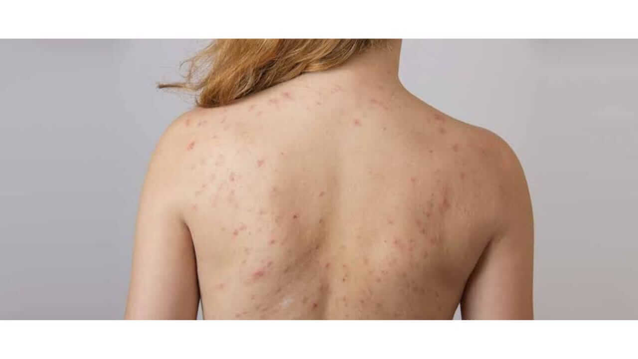 तुम्हाला पाठीच्या मुरुमांचा त्रास आहे का? ‘या’ घरगुती उपायांनी मिळवा चमकदार त्वचा…