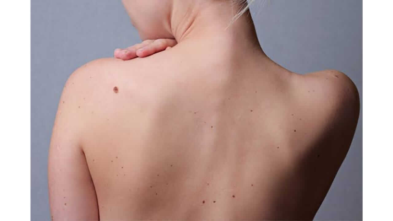 पाठीवर तीळ असलेल्या लोकांचे कसे असते व्यक्तिमत्व, जाणून घ्या काय सांगते सामुद्रिक शास्त्र