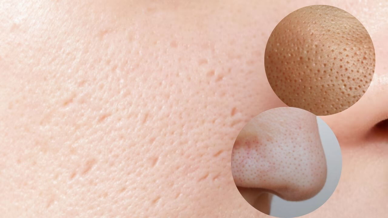 तुमच्याही चेहऱ्यावर ओपन पोर्सची समस्या वाढलीय? छिद्रे कमी करण्यासाठी ट्राय करा ‘हे’ घरगुती उपाय