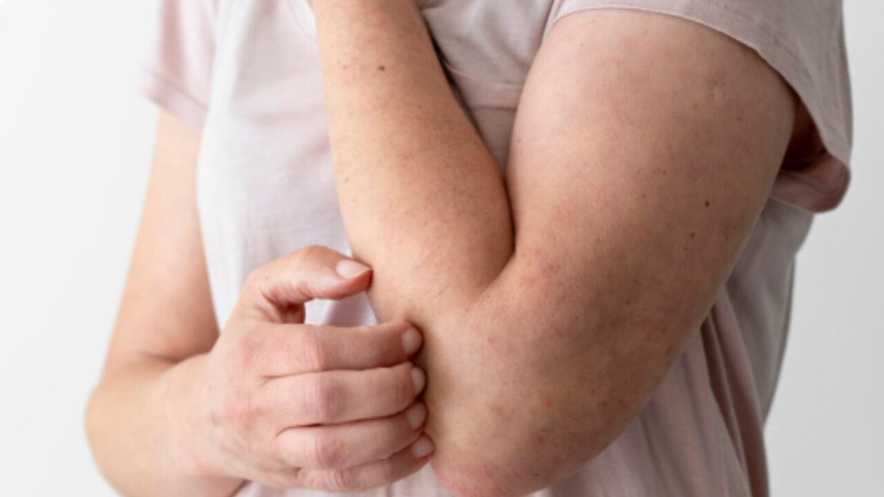 तुम्हालाही सतत जळजळतं, अंगावर पुरळ आणि खाज सुटते? मग पित्त कमी करण्यासाठी करा सोपे उपाय