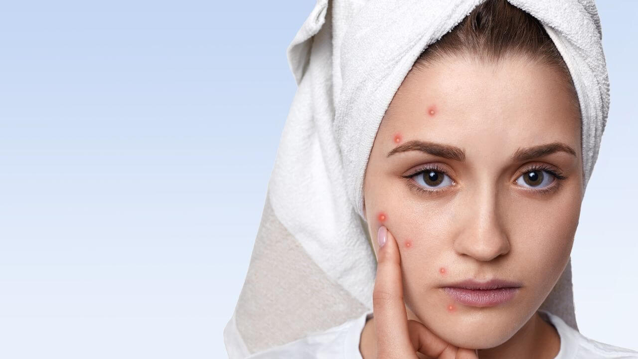 चेहऱ्यावरील पिंपल्स गायब करायचे आहेत? मग ट्राय करा ‘हा’ आयुर्वेदिक फेस पॅक