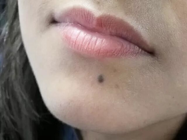 यदि चेहरे पर हो ज्यादा तिल तो ना समझे इसे lucky , यह हो सकता है मेलानोमा बीमारी , जाने इसके लक्षण