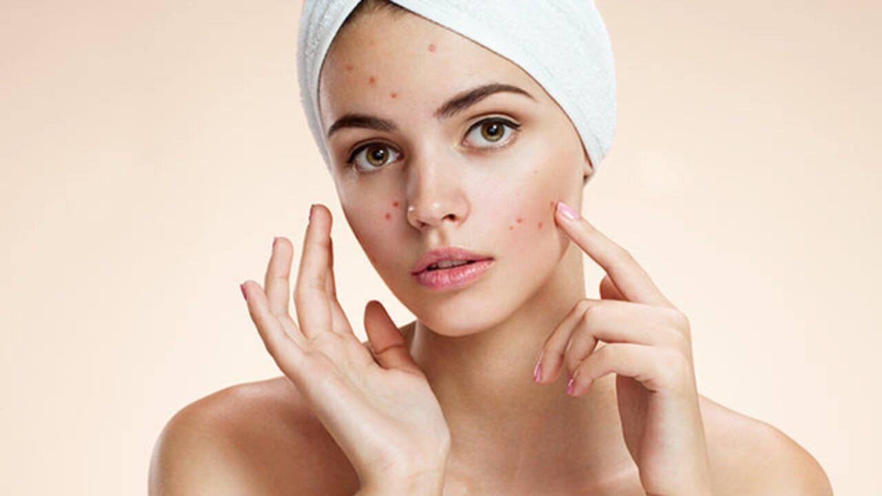मानसून में पिंपल्स की समस्या से कैसे रहें दूर? जान लें आसान से उपाय